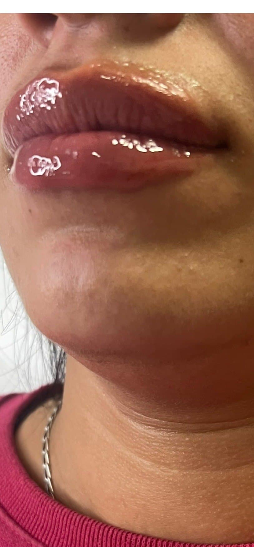 Depois · Preenchimento labial