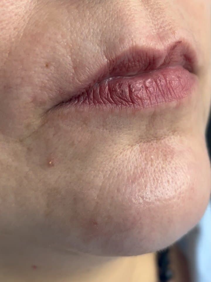 Antes · Preenchimento labial