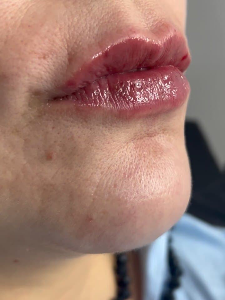 Depois · Preenchimento labial
